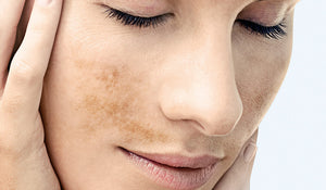 ¿Cómo tratar las manchas en la piel?